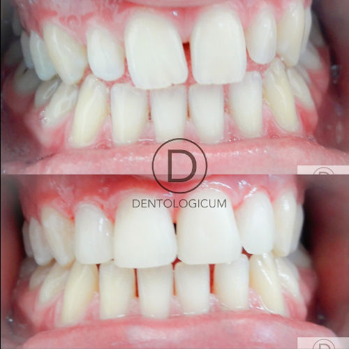 composite bonding