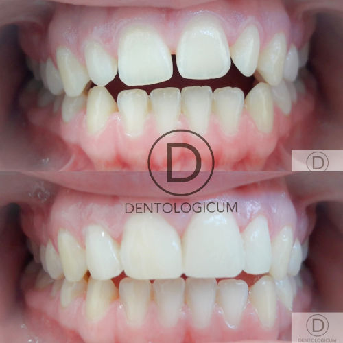 composite bonding
