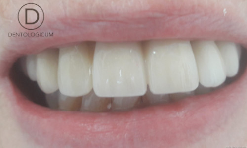 Implants - Bridge - Dentist Chester