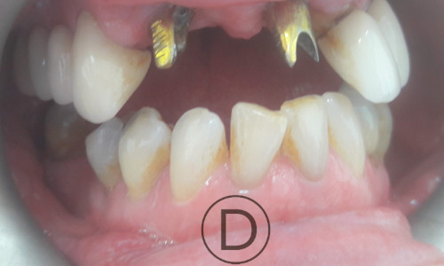 Implants - Golden Abutment - Dentist Chester