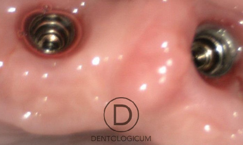  Implants - Open Screws - Dentist Chester
