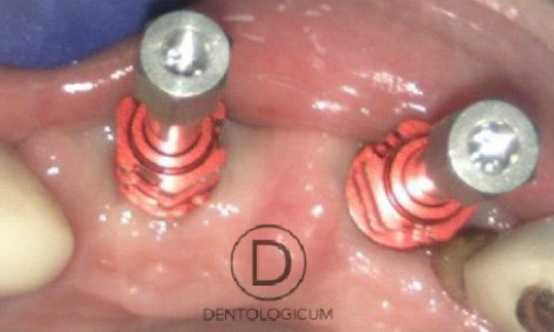 Implants - Red Impression Copings - Dentist Chester
