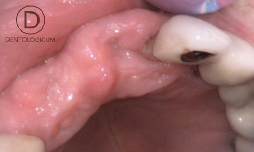 Implants - Toothless - Dentist Chester